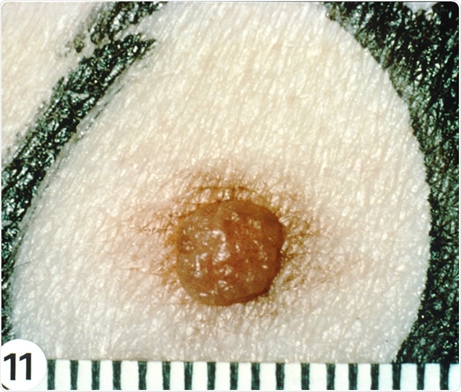 Dysplastic Nevi -  The delicate, hazy, tan macular rim of this lesion, although not clinically dramatic, represents persistent melanocytic proliferation beyond the lateral limits of the common mole at its center. Image Credit: National Cancer Institute